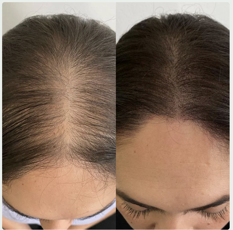 Before and after results from Emily C.